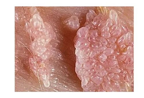 Lazerle siğil tedavisi nasıl yapılır?