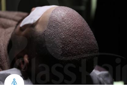 Saç Ekimi: Doğru Bilgilerle Saçlarınıza Yeniden Hayat Verin