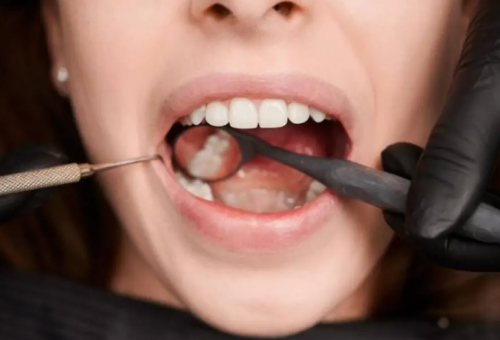 İstanbul İmplant Fiyatları Ne Kadar?